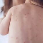 سندھ میں خسرہ کی وبا شدت اختیار کر گئی، 40 اموات رپورٹ