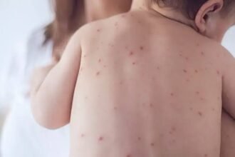 سندھ میں خسرہ کی وبا شدت اختیار کر گئی، 40 اموات رپورٹ