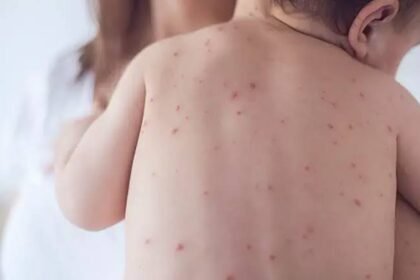 سندھ میں خسرہ کی وبا شدت اختیار کر گئی، 40 اموات رپورٹ