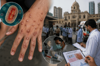 Monkeypox Rocks Karachi as Tenth Case Reported
