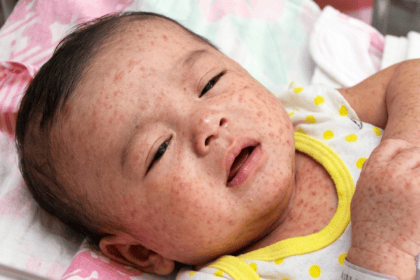 US Measles Infections Hit 35-Year High, Surpassing 2025 Tally in Just Seven Months