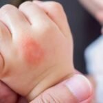 6 Home Remedies for Mosquito Bites
