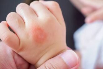 6 Home Remedies for Mosquito Bites