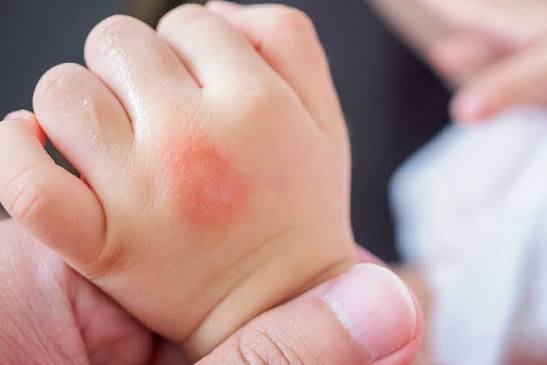 6 Home Remedies for Mosquito Bites