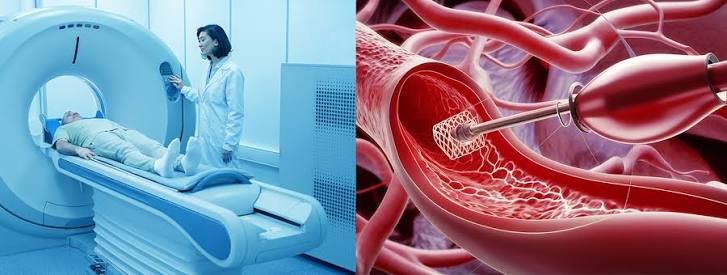 Functional Angiography Cuts Heart Risks in STEMI Patients